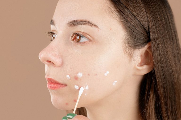 Jakie są sposoby na leczenie trądziku?